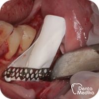 Doplnění kosti dolní čelisti - Dentamedika Brno